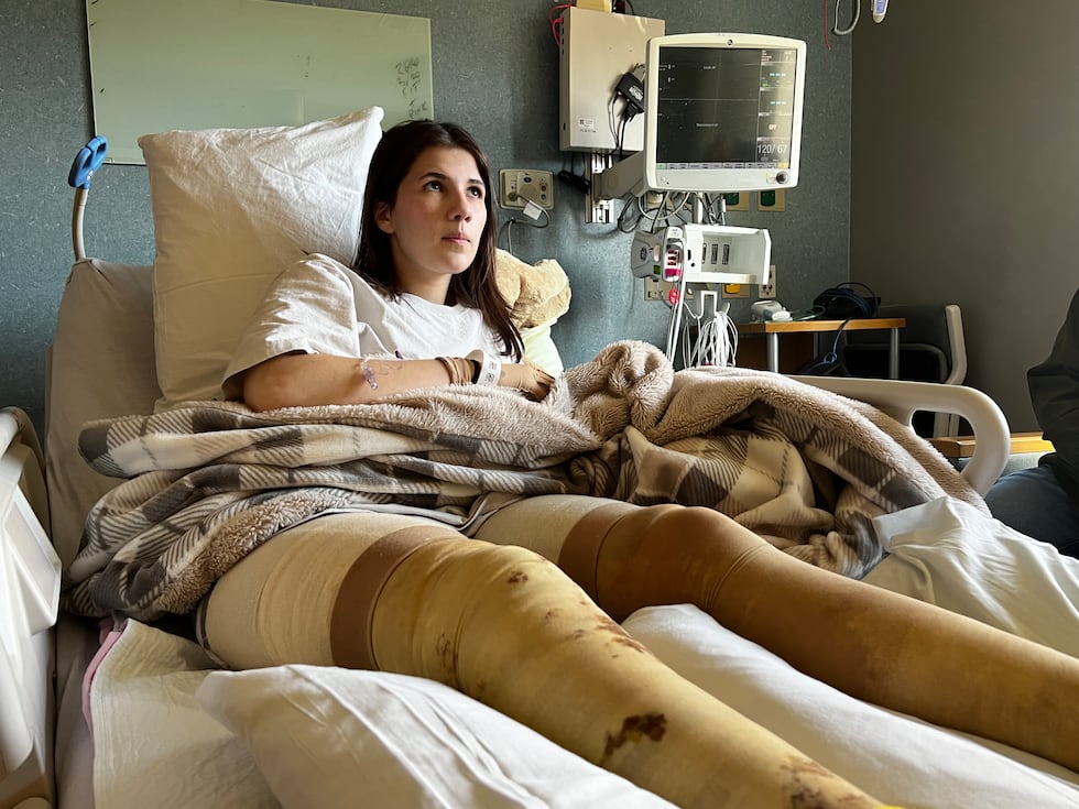 Accelerant Burn Woman suffers severe burns after friend pours accelerant on bonfire: ‘I ...
